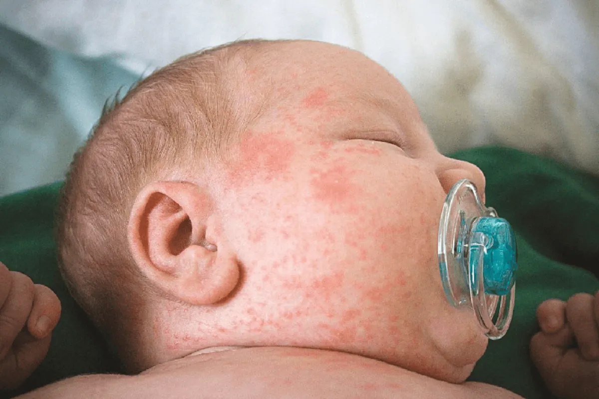 Dấu hiệu phân biệt giúp cha mẹ nhận biết kịp thời khi nào cần đưa bé đi khám (Ảnh: sưu tầm internet).