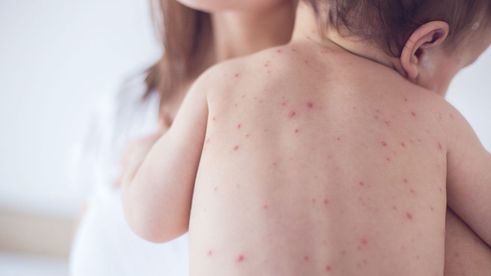 Theo dõi nhiệt độ và các dấu hiệu bất thường là công việc tối quan trọng khi chăm sóc trẻ sốt xuất huyết (Ảnh: sưu tầm internet).