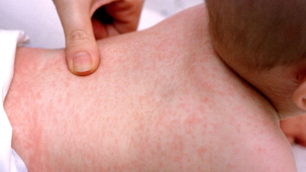 Phân biệt đúng các triệu chứng giúp cha mẹ không chủ quan trước những dấu hiệu nguy hiểm của sốt xuất huyết (Ảnh: sưu tầm internet).