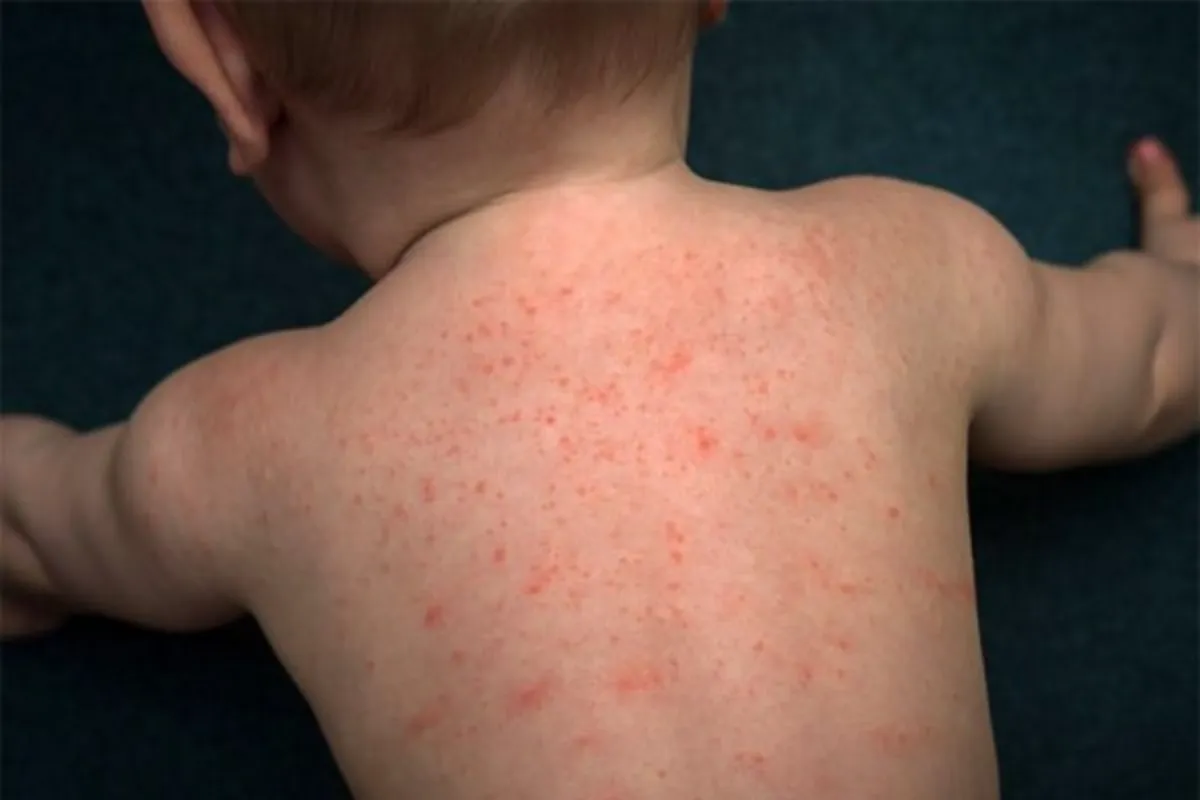 Dấu hiệu bé bị dị ứng tôm