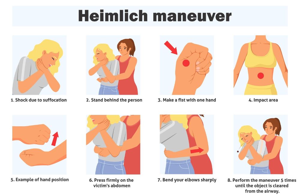 Thủ thuật Heimlich (Cấp cứu hóc dị vật)