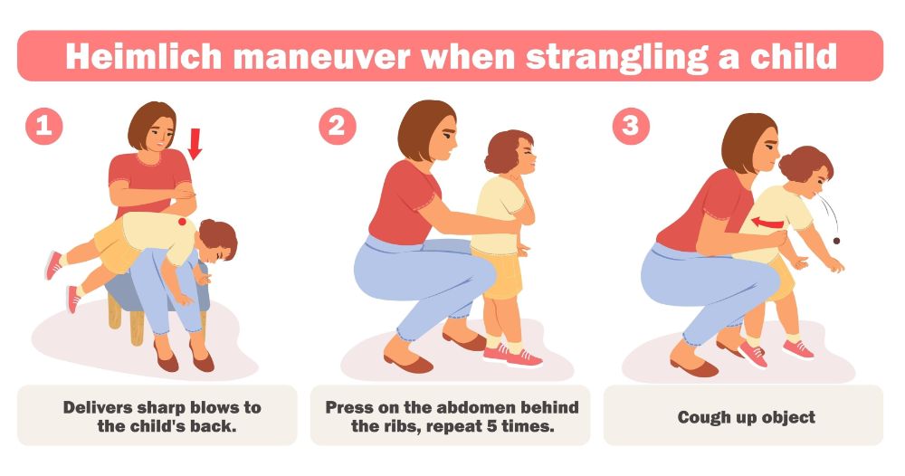 Kỹ thuật vỗ lưng ấn ngực đúng cách để khai thông đường thở cho trẻ dưới 1 tuổi (Ảnh: sưu tầm internet).