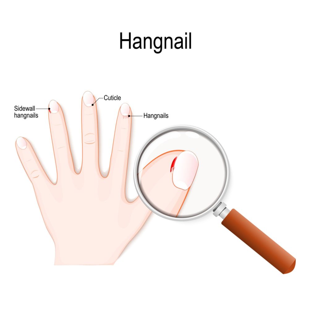 Xước măng rô là hiện tượng bong lớp biểu bì quanh móng, rất thường gặp ở trẻ sơ sinh và trẻ nhỏ (Ảnh: sưu tầm internet).