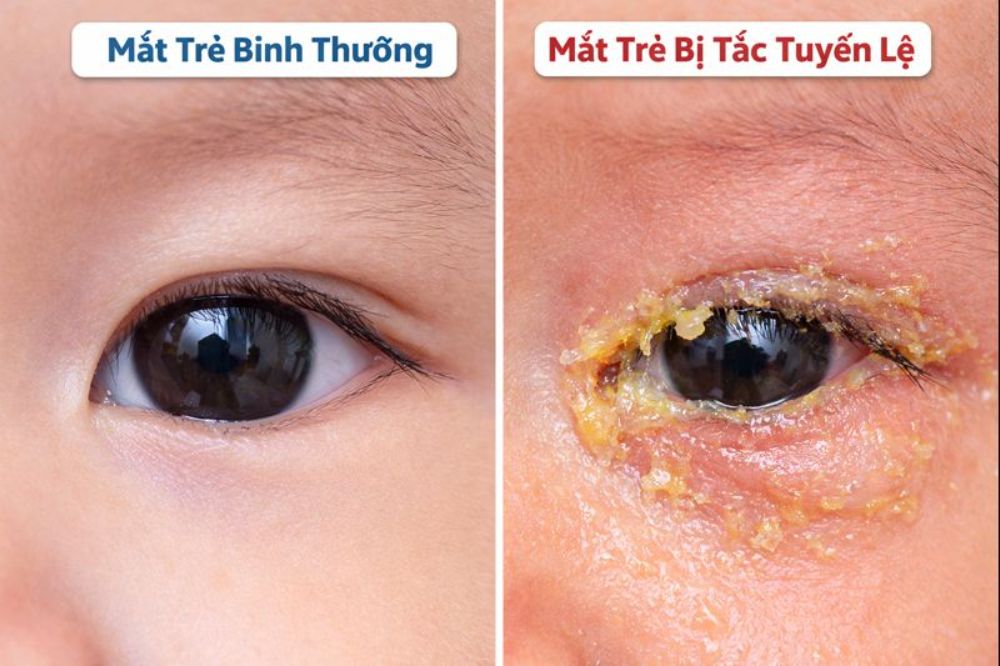 Mẹ cần phân biệt khóc không nước mắt do sinh lý và do tắc tuyến lệ để có cách vệ sinh mắt phù hợp.