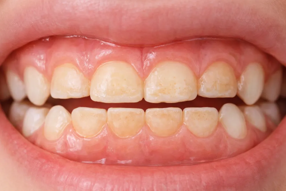 Bào mòn men răng là một trong những hậu quả vật lý phổ biến nhất nếu để bé nghiến răng kéo dài.