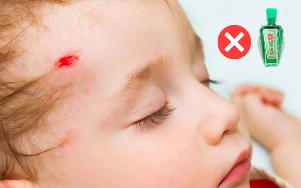 Tuyệt đối không thoa dầu nóng hay xoa bóp mạnh lên vết sưng bầm trên đầu trẻ.