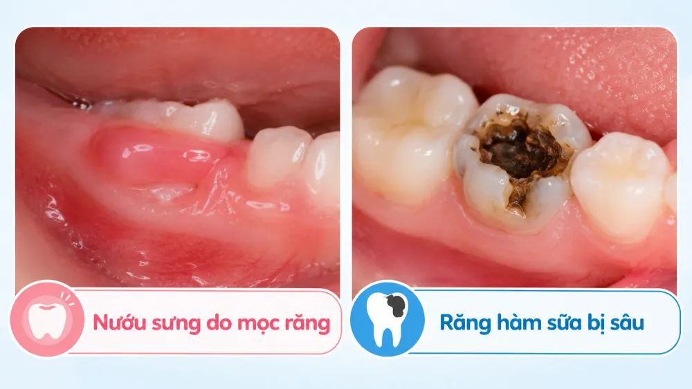 Cha mẹ cần phân biệt rõ tình trạng nướu sưng do mọc răng và răng hàm bị sâu đen để có hướng xử lý kịp thời.